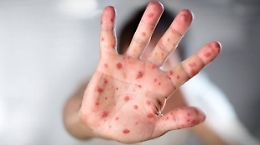 Morbillo, nel 2018 segnalati 2.368 casi: in Sicilia l'incidenza pi&ugrave; alta