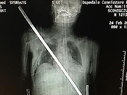 «Io, trafitto da una barra di ferro salvato dagli "angeli" del Cannizzaro»