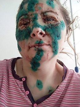 Farmacista di Kharkiv sfigurata dai bombardamenti: il Ministero mostra la foto