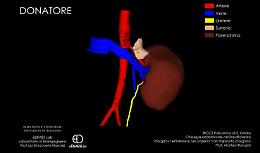 Il trapianto di rene senza anestesia: miracolo della chirurgia a Bologna
